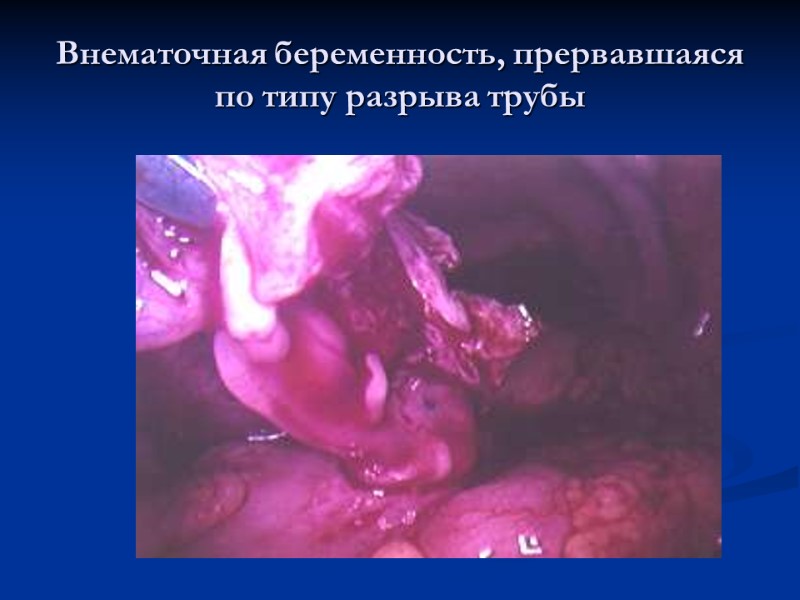 Внематочная беременность, прервавшаяся по типу разрыва трубы